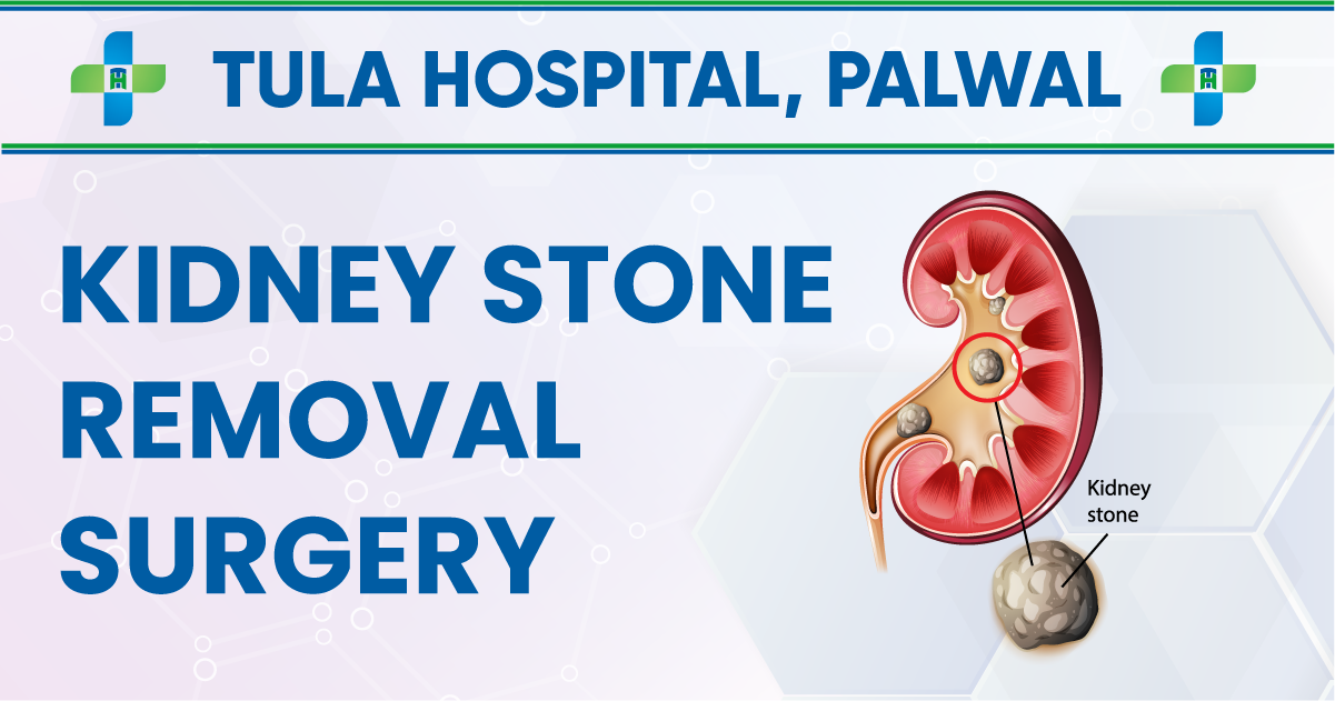 Kidney Stone Removal Surgery - My Blog